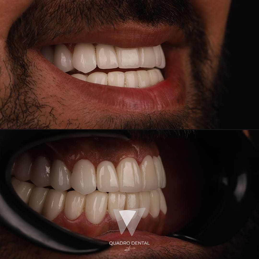 Résultats après un traitement Sourire Hollywoodien chez Quadro Dental