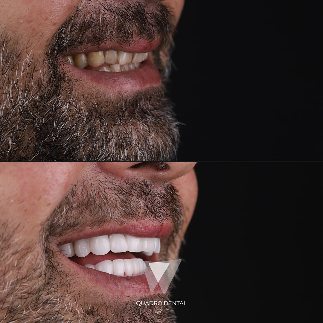 Résultats avant et après un traitement Sourire Hollywoodien chez Quadro Dental