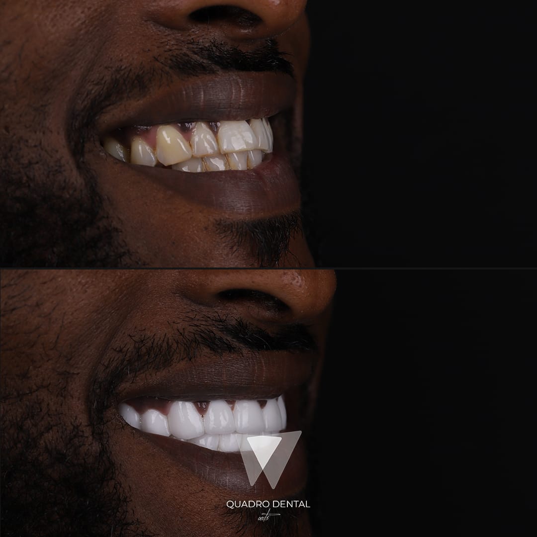 Résultats avant et après un traitement Sourire Hollywoodien chez Quadro Dental