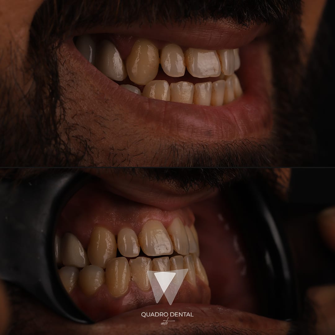 Résultats avant un traitement Sourire Hollywoodien chez Quadro Dental