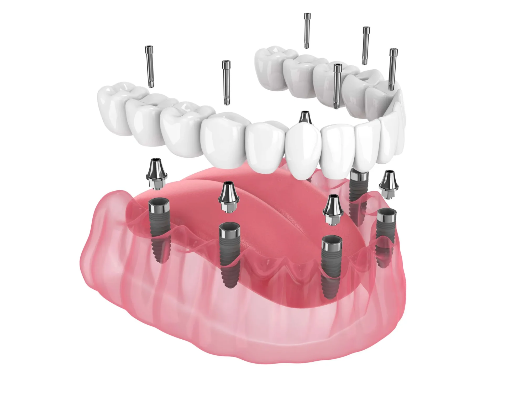 Implants dentaires All On 6 chez Quadro Dental